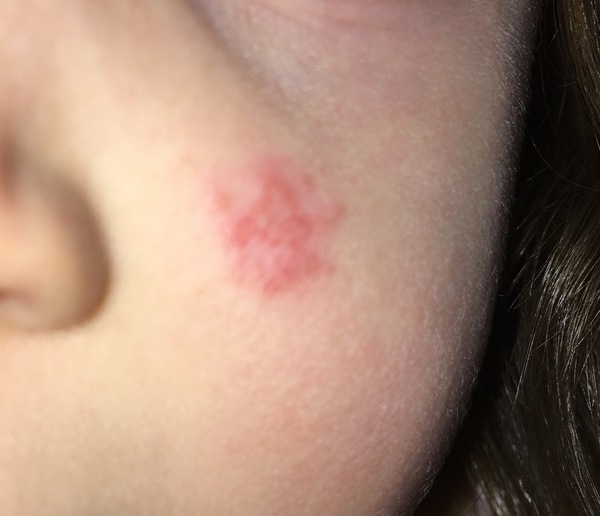 Anyone fancy a game of 'name that rash'