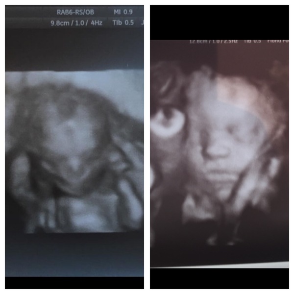 Pregnant at forty and over - thread 3