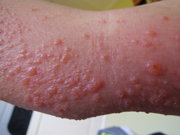 Molluscum Contagiosum