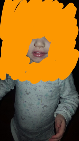 22m DD's nose - WWYD