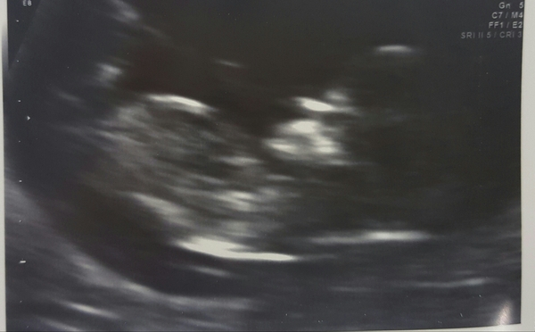 Nub theory, boy or girl?