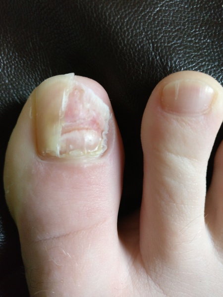 Manky foot