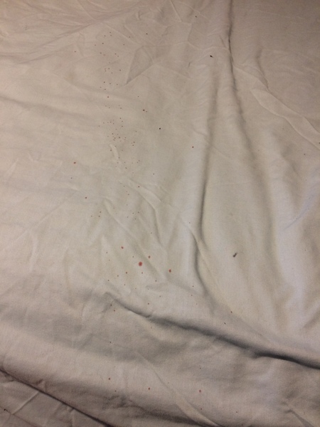 Proud of huge boil explosion