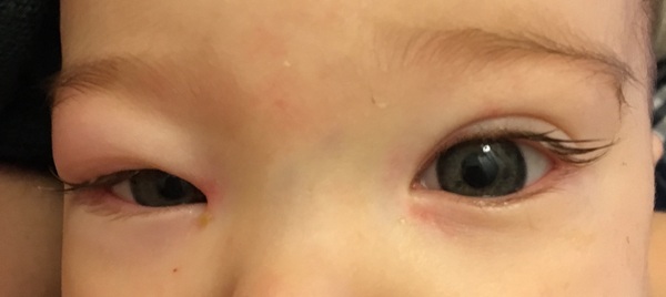 Could this be cellulitis (photo)?