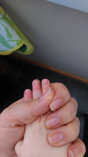 Baby fingernail (photo) what is this and will it go away on its own? Or