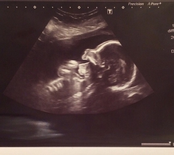 May 2017 #5 - 20 week scans and pram buying plans