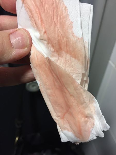 Sorry - a bit gross - but any gynaecologists out there?