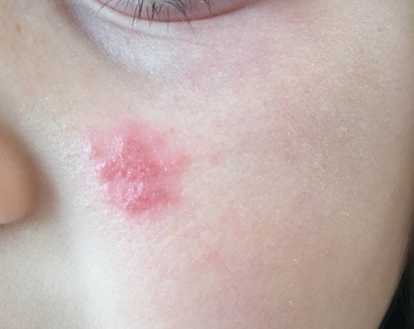 Anyone fancy a game of 'name that rash'
