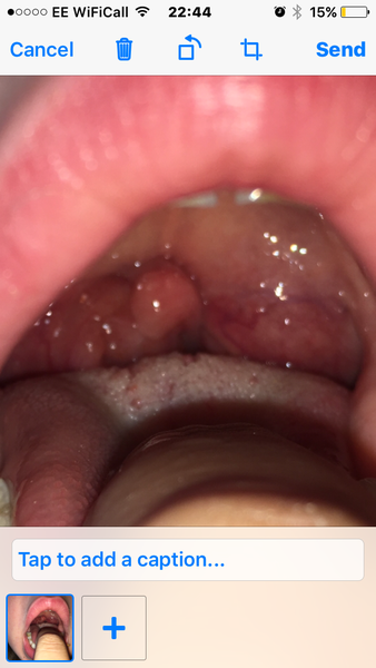 Enlarged tonsils, terrible sleeper, bad sleeper, ent consultant won't take tonsils out 😡😡