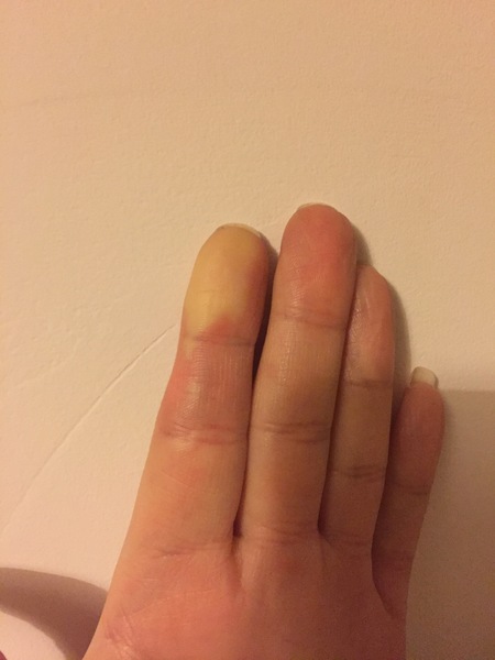 Possible Reynaud's syndrome?