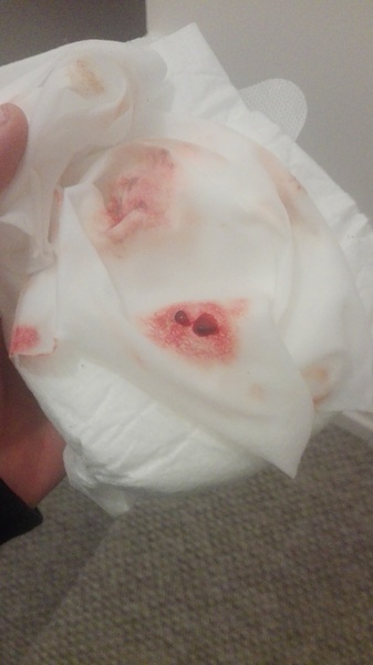 Please help! Baby brought up fresh vlood with clots :(