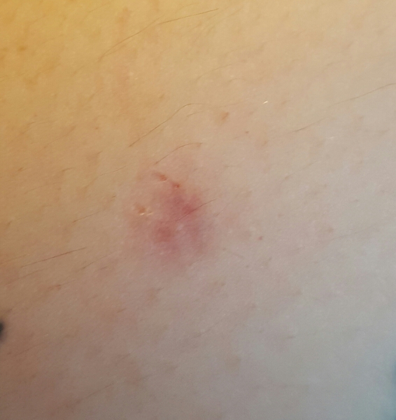 Puppy biting.  Broken skin.