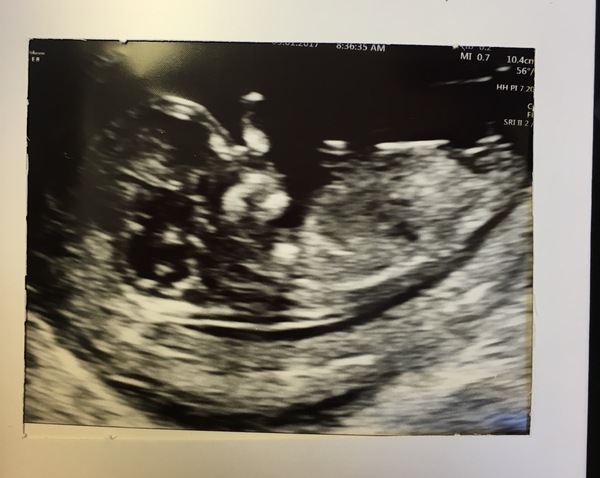 Boy or Girl? Dying to find out