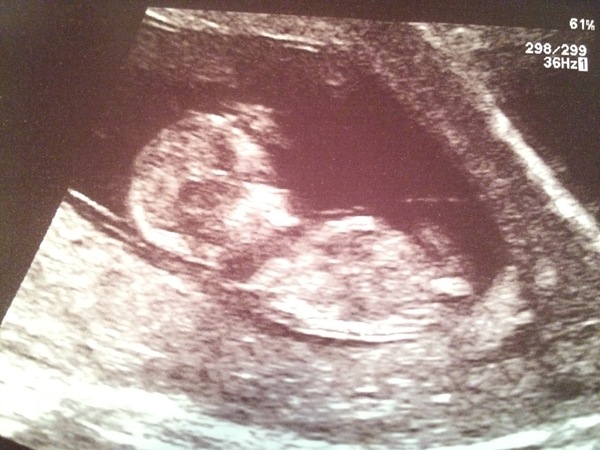 12wk scan, guesses on the sex anyone?