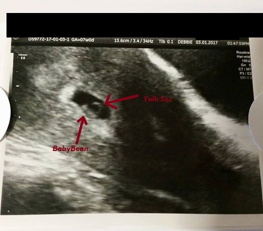Empty sac on abdominal scan 6wks+3 days