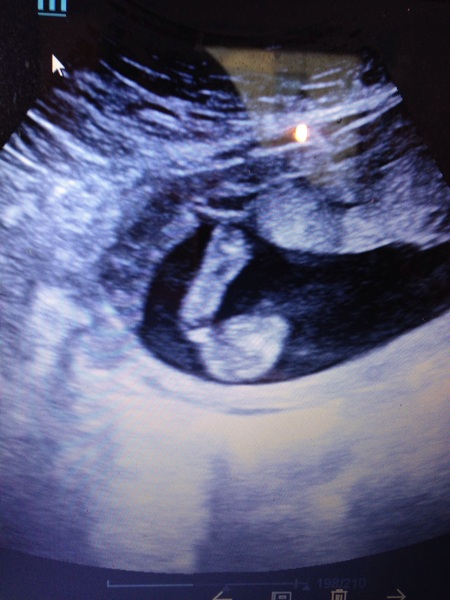 does this look like a girl on my gender scan ???