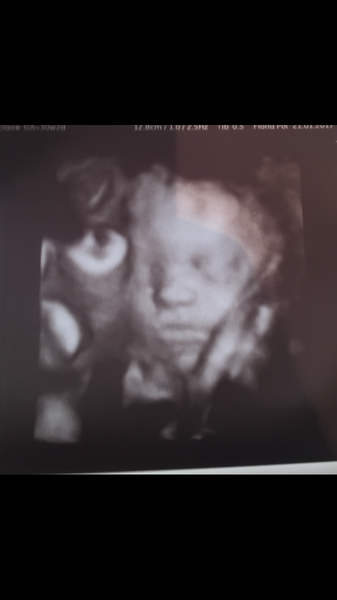 Pregnant at forty and over - thread 3