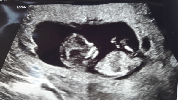 Another guess the gender! Didnt think I wanted to find out but have changed my mind ...