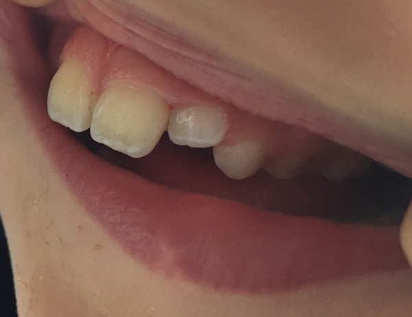 Any dentists out there please?  Pic attached, 8 year old has a big tooth growing in at an angle ...