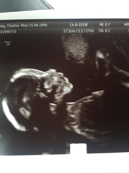 Gender guesses? 20 weeks