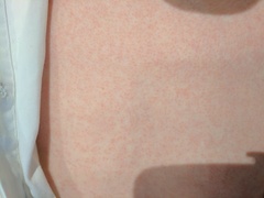 Allergy? Post viral? Who can help with this rash...