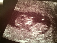 12wk scan, guesses on the sex anyone?