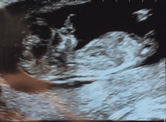 12 week scan