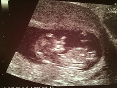12wk scan, guesses on the sex anyone?