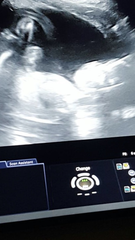 Hyperemesis Support