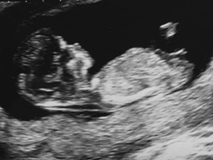 12 week scan