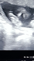 Hyperemesis Support