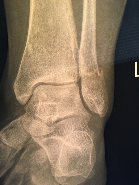 Broken ankle - poor bone density?
