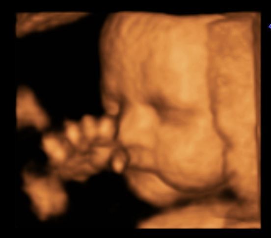 Pregnancy after infertility III