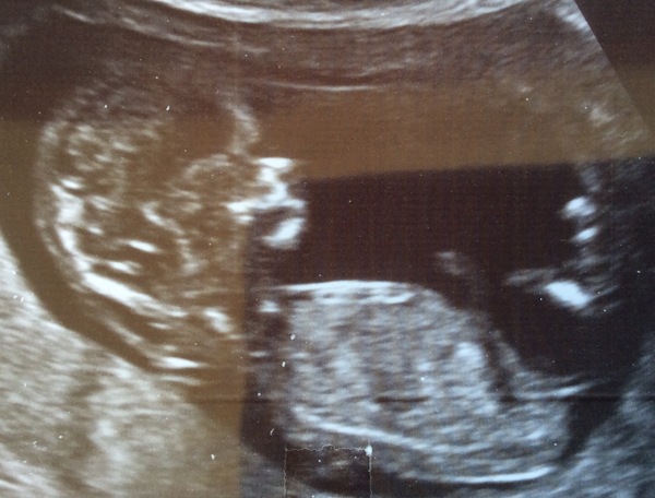 Nub-less baby :-/   (Where's the frickin's nub?!)