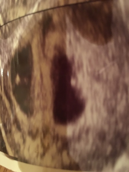 October Babies #2 - midwife appointments and "scanxiety"