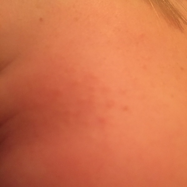 Weird bumps on face