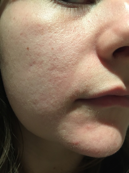 Ditch The Foundation, Embrace Some Fantastic Skincare Instead!