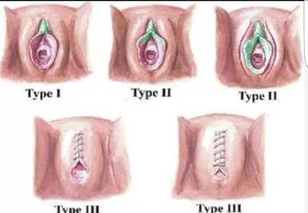 FGM (female genital mutilation)