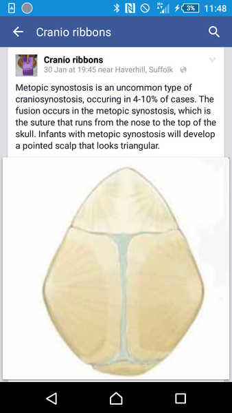 I will try again...Microchephaly