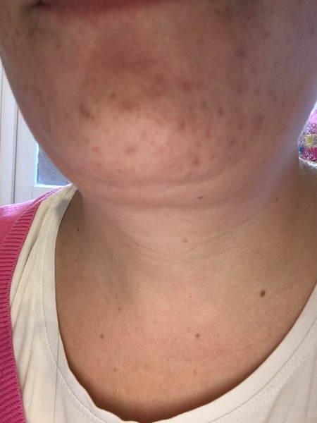 Look at my chin please and tell me please what to get to repair it !!