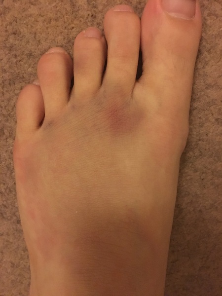 I've done something really weird to my foot