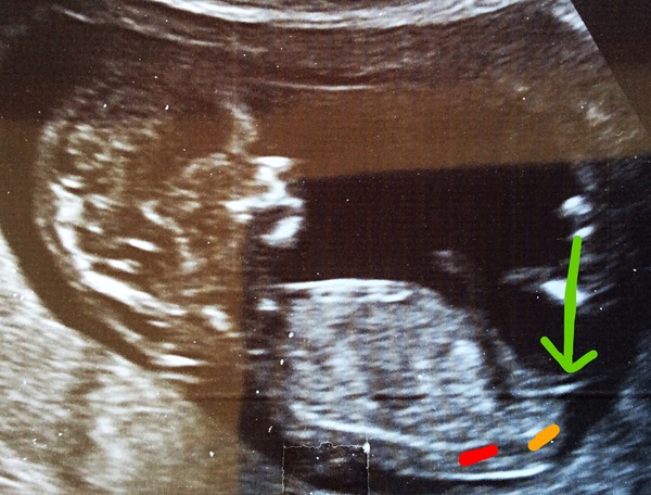 Nub-less baby :-/   (Where's the frickin's nub?!)