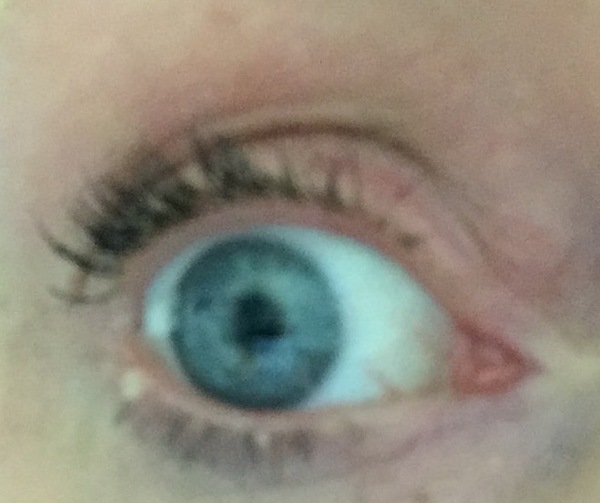 Had anyone successfully got rid of eyelid milia?