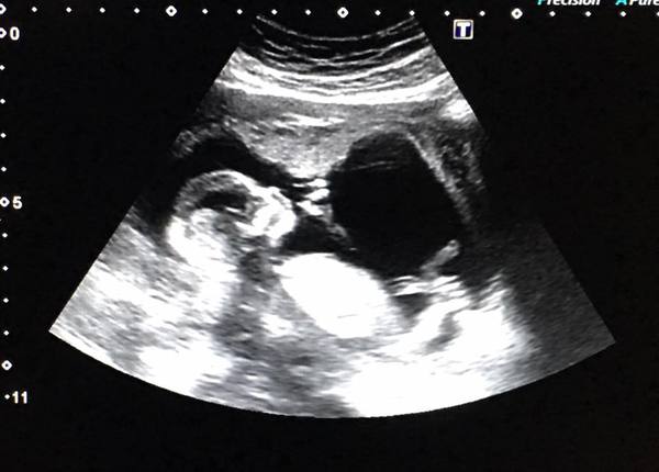 August 2017: the one in which we'll get midwife appointment