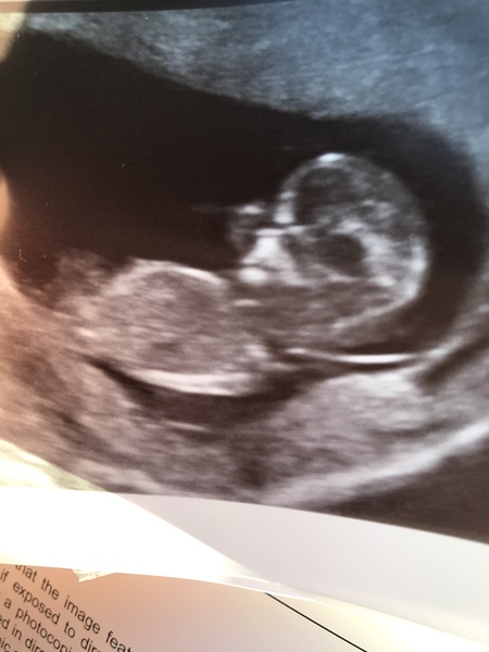 12+4 week scan - nub / skull guesses x