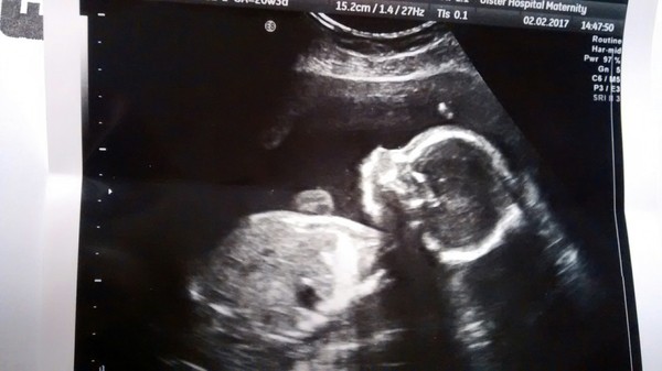 Due in June 2017, 20 weeks scans and beyond!