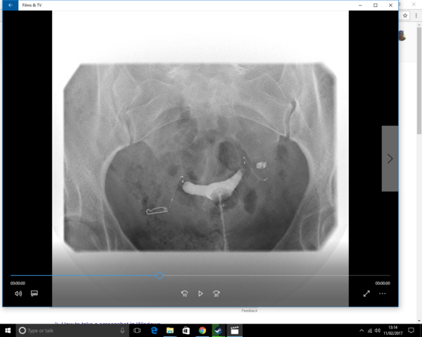 Essure permanent sterilisation