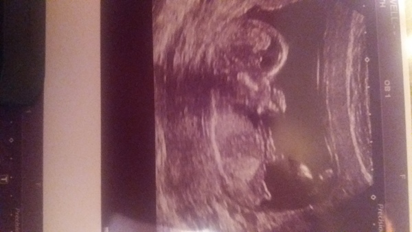 12 week scan/ nub theory?