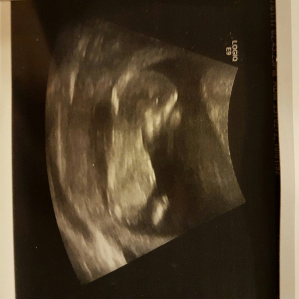 12 week scan/ nub theory?