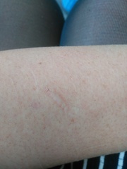 To ask if you'd judge someone if they had obviously self harm scars?